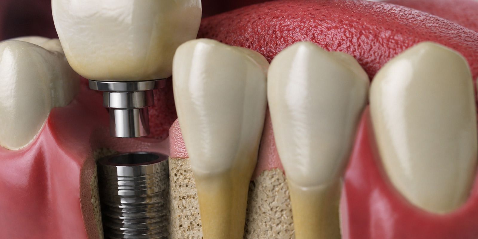 Implantología Dental