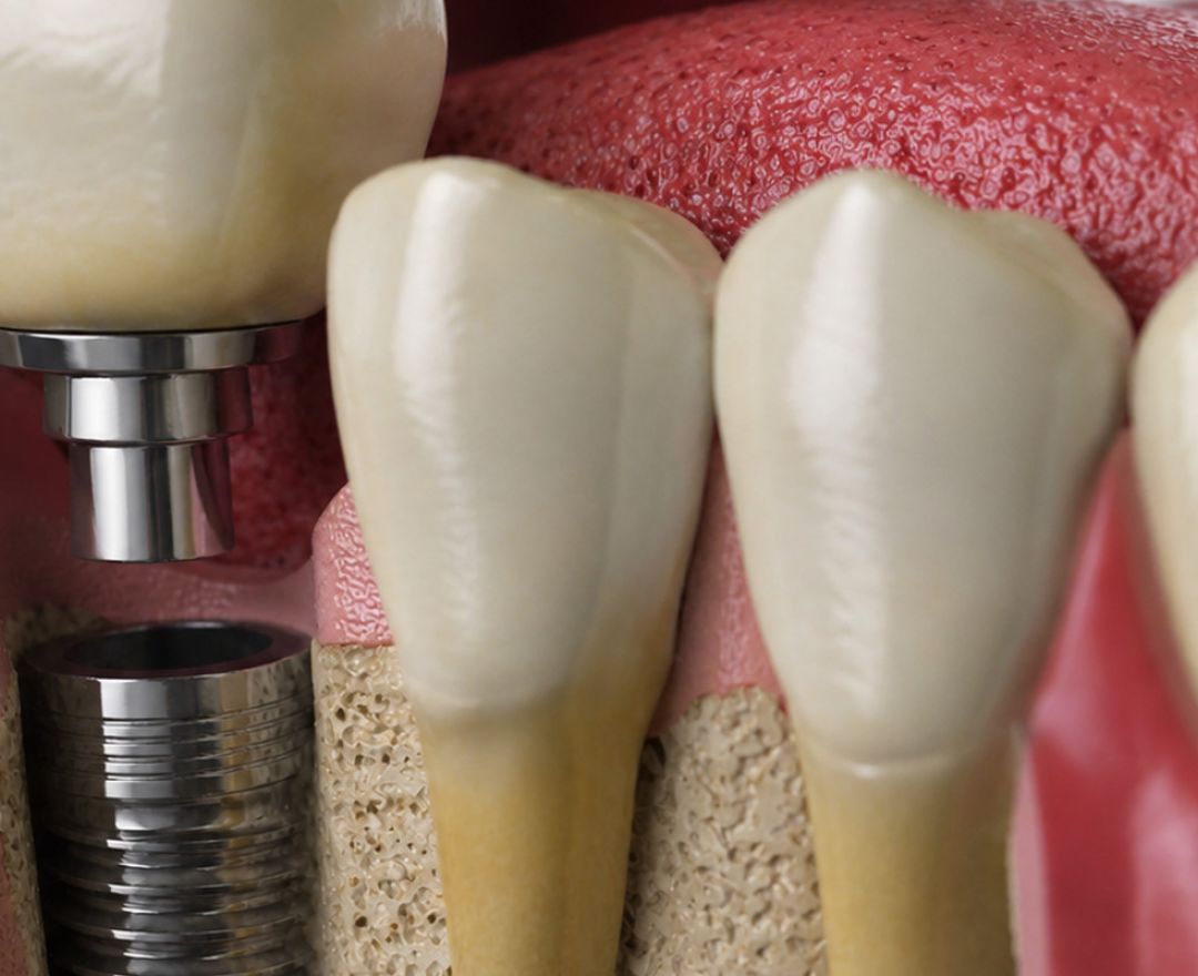 Implantología Dental